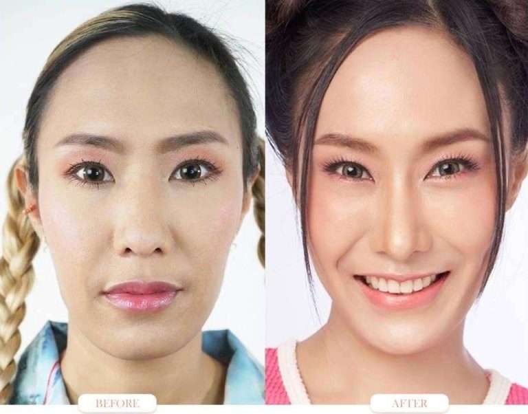 nose reduction , ลดขนาดจมูก
