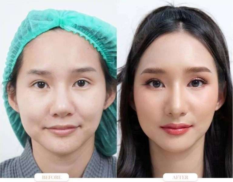 nose reduction , ลดขนาดจมูก