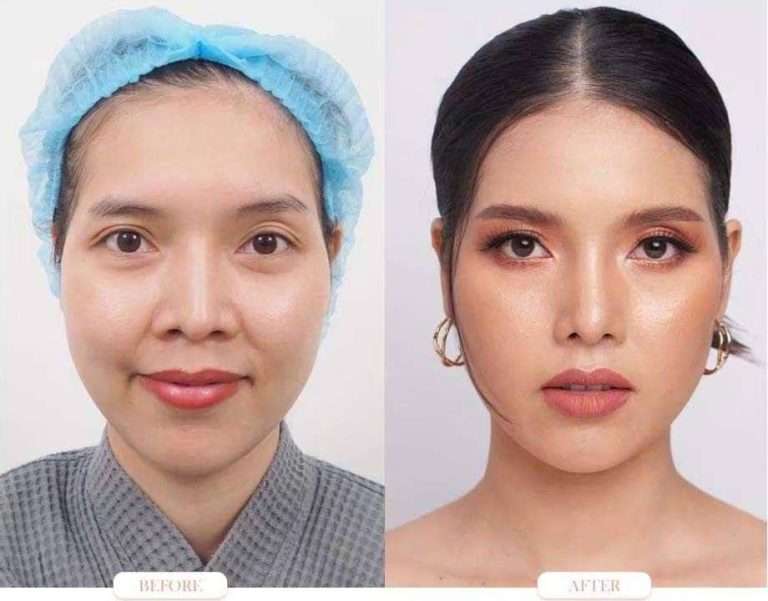 nose reduction , ลดขนาดจมูก