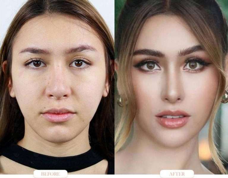 nose reduction , ลดขนาดจมูก