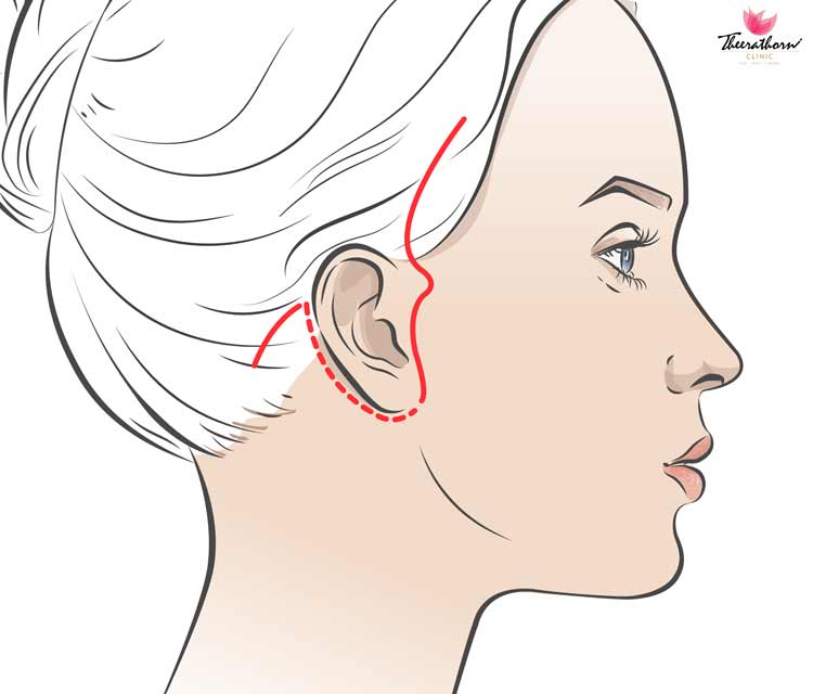 scarless facelift