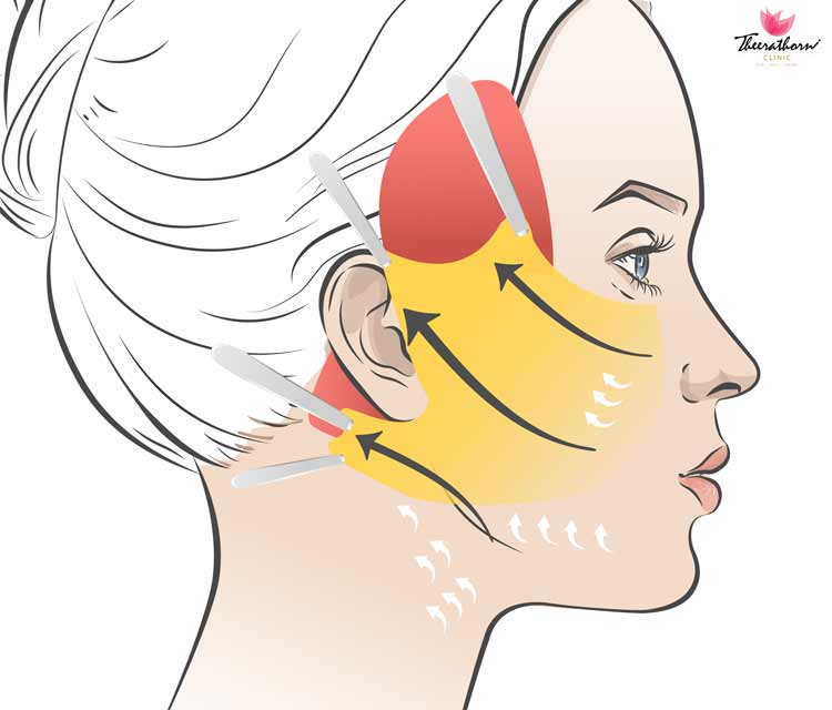scarless facelift