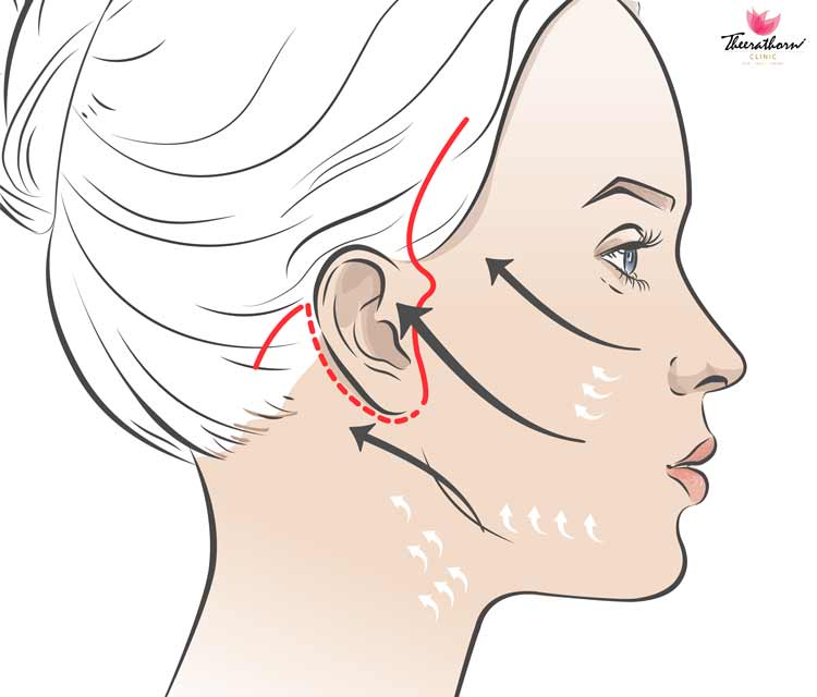 scarless facelift