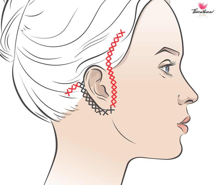 scarless facelift
