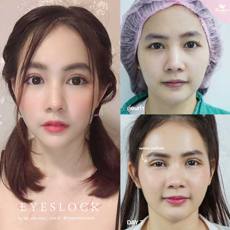 ตาสองชั้น , กรีดยาว , ตาตี่