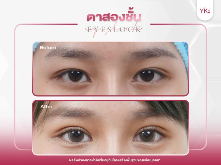 ภาพก่อนหลังทำตาสองชั้น , ภาพก่อนหลังแก้ตาสองชั้น