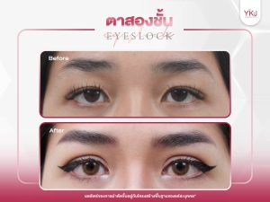 ภาพก่อนหลังทำตาสองชั้น , ภาพก่อนหลังแก้ตาสองชั้น