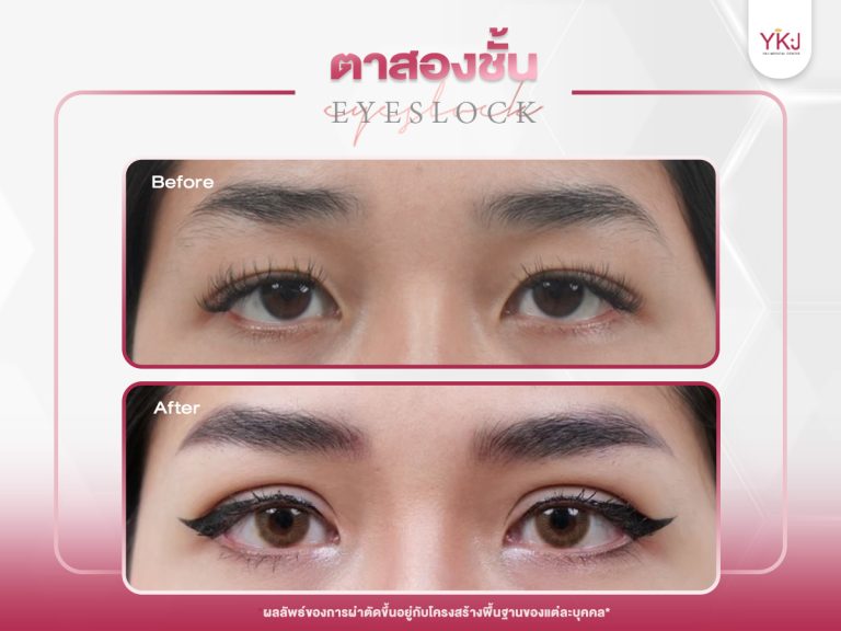 ภาพก่อนหลังทำตาสองชั้น , ภาพก่อนหลังแก้ตาสองชั้น