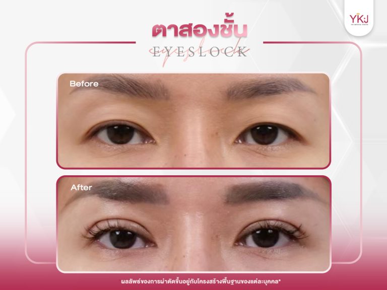 ภาพก่อนหลังทำตาสองชั้น , ภาพก่อนหลังแก้ตาสองชั้น