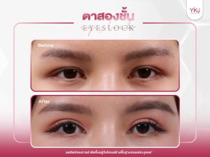 ภาพก่อนหลังทำตาสองชั้น , ภาพก่อนหลังแก้ตาสองชั้น