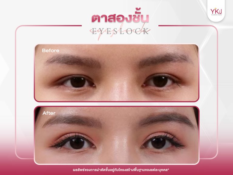 ภาพก่อนหลังทำตาสองชั้น , ภาพก่อนหลังแก้ตาสองชั้น