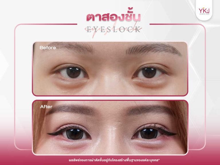 ภาพก่อนหลังทำตาสองชั้น , ภาพก่อนหลังแก้ตาสองชั้น