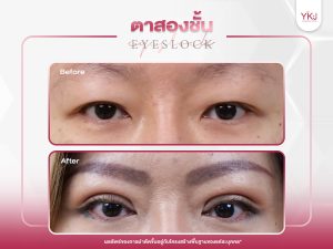 ภาพก่อนหลังทำตาสองชั้น , ภาพก่อนหลังแก้ตาสองชั้น
