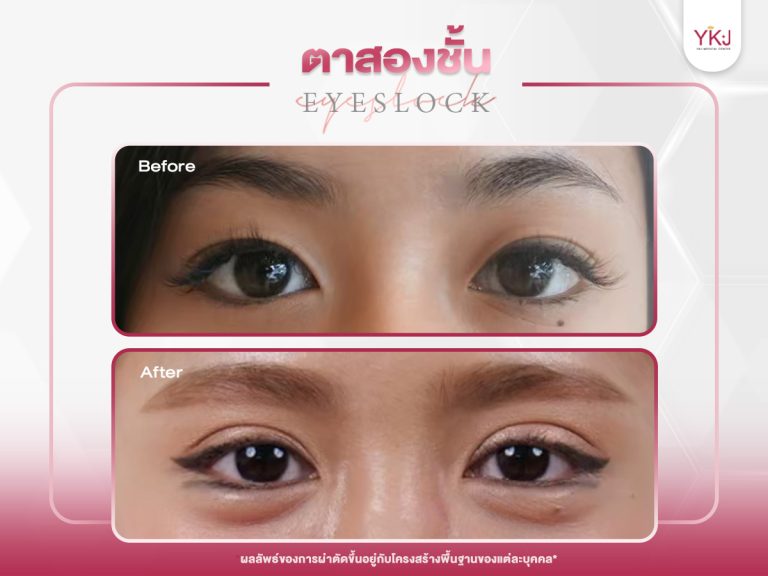 ภาพก่อนหลังทำตาสองชั้น , ภาพก่อนหลังแก้ตาสองชั้น