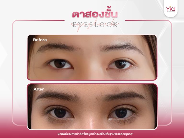 ภาพก่อนหลังทำตาสองชั้น , ภาพก่อนหลังแก้ตาสองชั้น