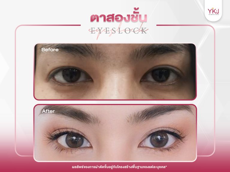 ภาพก่อนหลังทำตาสองชั้น , ภาพก่อนหลังแก้ตาสองชั้น