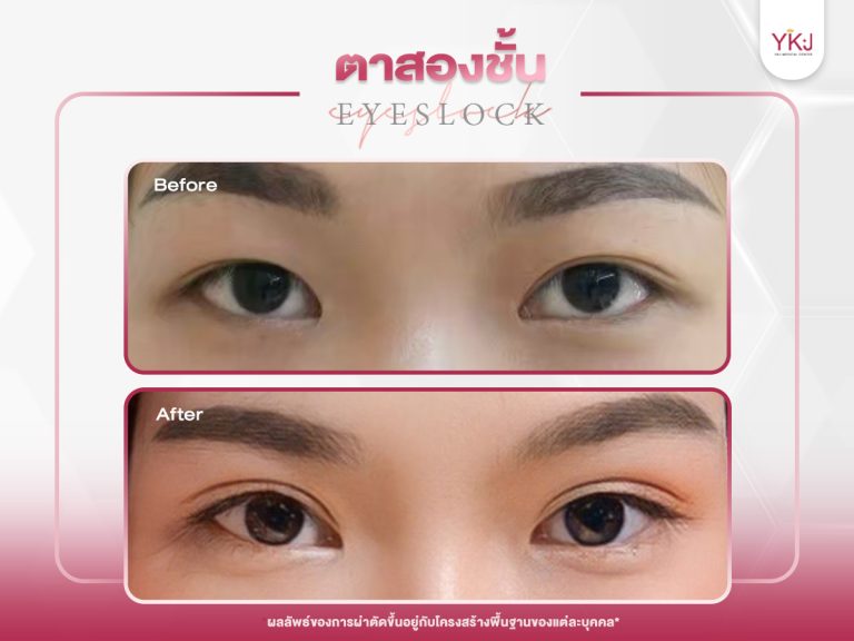 ภาพก่อนหลังทำตาสองชั้น , ภาพก่อนหลังแก้ตาสองชั้น