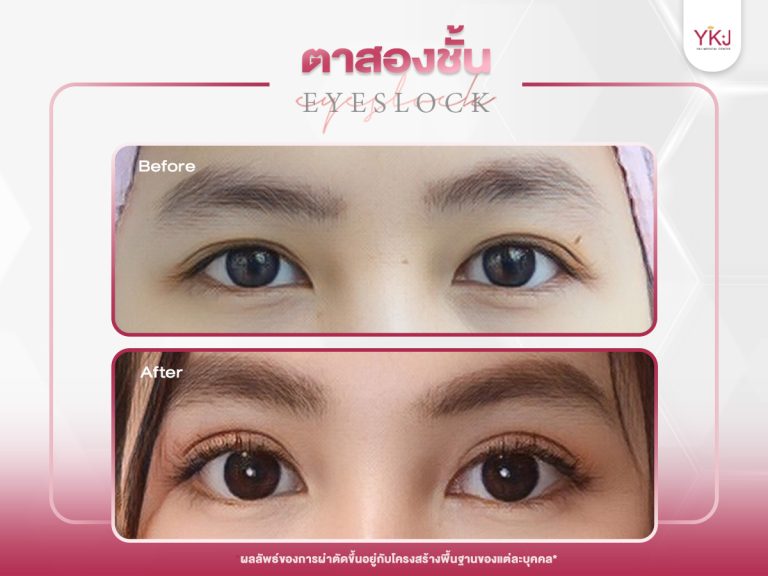 ภาพก่อนหลังทำตาสองชั้น , ภาพก่อนหลังแก้ตาสองชั้น