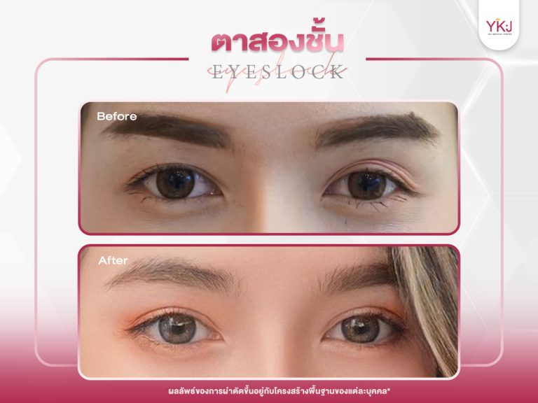 ภาพก่อนหลังทำตาสองชั้น , ภาพก่อนหลังแก้ตาสองชั้น