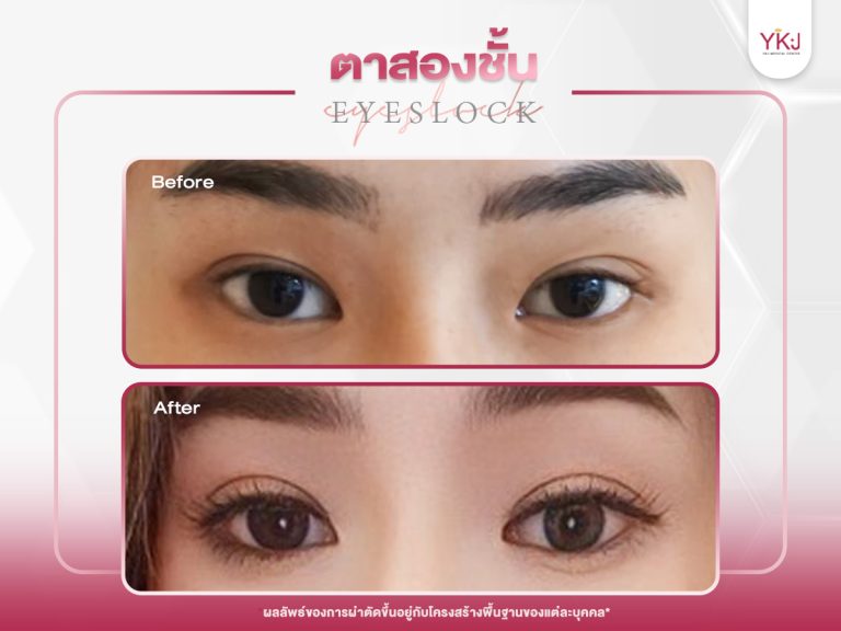 ภาพก่อนหลังทำตาสองชั้น , ภาพก่อนหลังแก้ตาสองชั้น