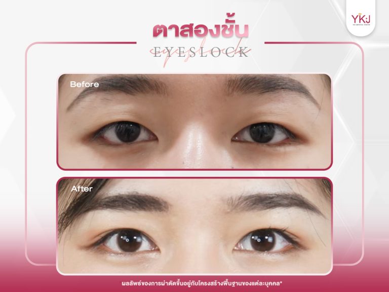 ภาพก่อนหลังทำตาสองชั้น , ภาพก่อนหลังแก้ตาสองชั้น