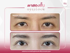 ภาพก่อนหลังทำตาสองชั้น , ภาพก่อนหลังแก้ตาสองชั้น