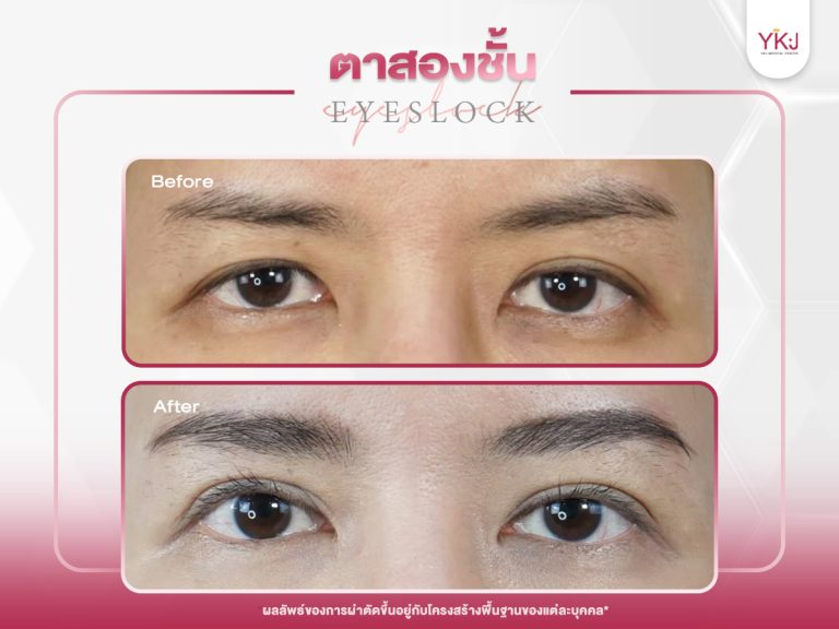 ภาพก่อนหลังทำตาสองชั้น , ภาพก่อนหลังแก้ตาสองชั้น