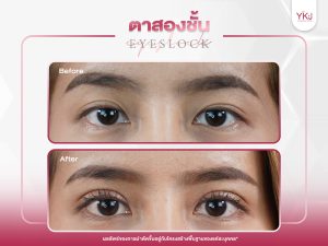 ภาพก่อนหลังทำตาสองชั้น , ภาพก่อนหลังแก้ตาสองชั้น
