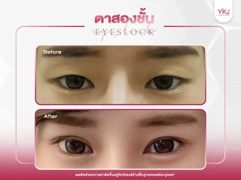 ภาพก่อนหลังทำตาสองชั้น , ภาพก่อนหลังแก้ตาสองชั้น