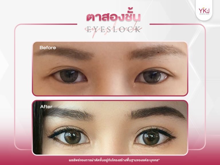 ภาพก่อนหลังทำตาสองชั้น , ภาพก่อนหลังแก้ตาสองชั้น