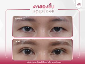 ภาพก่อนหลังทำตาสองชั้น , ภาพก่อนหลังแก้ตาสองชั้น