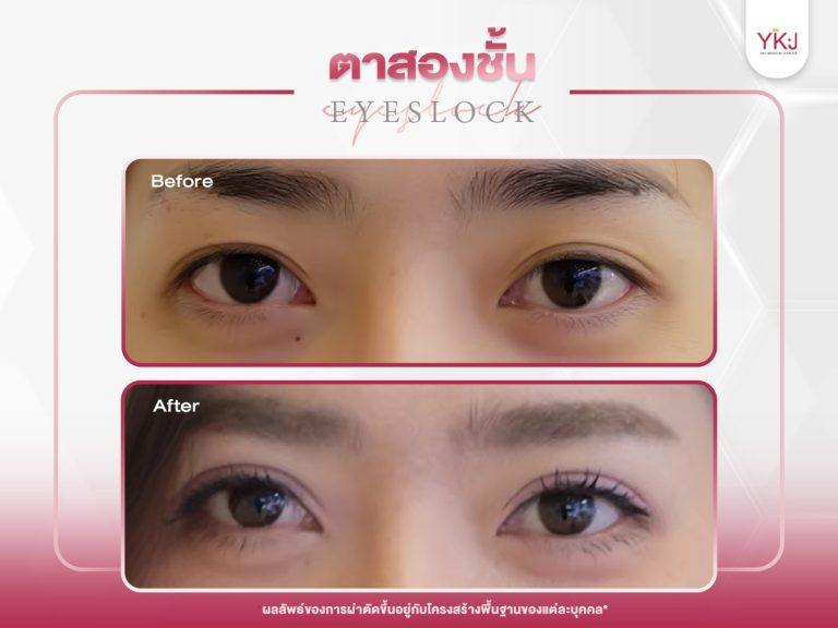 ภาพก่อนหลังทำตาสองชั้น , ภาพก่อนหลังแก้ตาสองชั้น