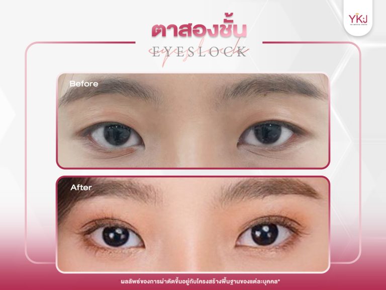 ภาพก่อนหลังทำตาสองชั้น , ภาพก่อนหลังแก้ตาสองชั้น