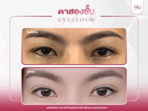 ภาพก่อนหลังทำตาสองชั้น , ภาพก่อนหลังแก้ตาสองชั้น