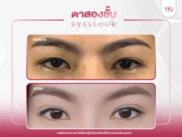 ภาพก่อนหลังทำตาสองชั้น , ภาพก่อนหลังแก้ตาสองชั้น