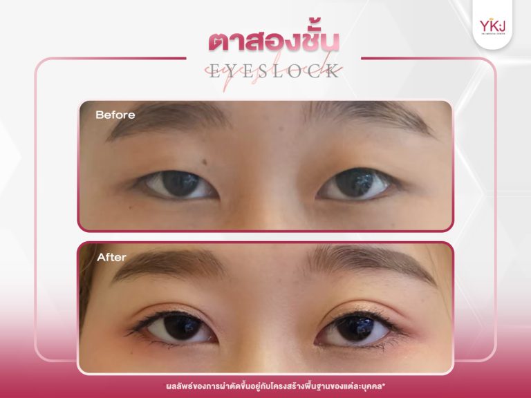 ภาพก่อนหลังทำตาสองชั้น , ภาพก่อนหลังแก้ตาสองชั้น