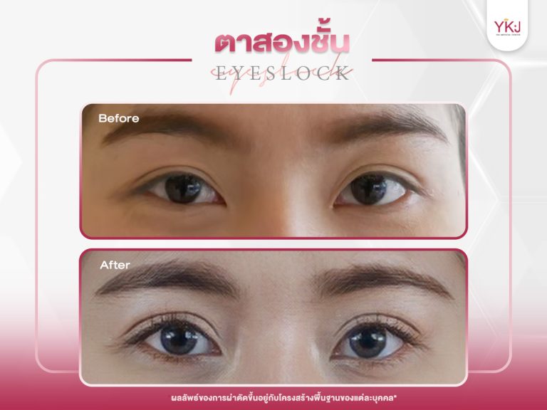 ภาพก่อนหลังทำตาสองชั้น , ภาพก่อนหลังแก้ตาสองชั้น