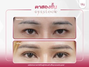 ภาพก่อนหลังทำตาสองชั้น , ภาพก่อนหลังแก้ตาสองชั้น
