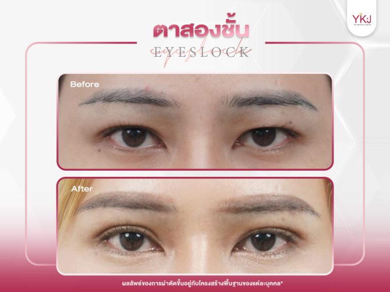 ภาพก่อนหลังทำตาสองชั้น , ภาพก่อนหลังแก้ตาสองชั้น