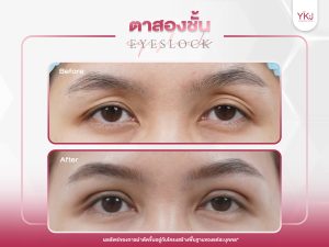 ภาพก่อนหลังทำตาสองชั้น , ภาพก่อนหลังแก้ตาสองชั้น