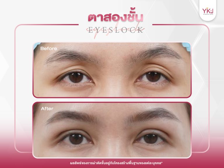 ภาพก่อนหลังทำตาสองชั้น , ภาพก่อนหลังแก้ตาสองชั้น