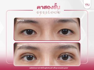 ภาพก่อนหลังทำตาสองชั้น , ภาพก่อนหลังแก้ตาสองชั้น