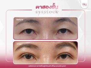 ภาพก่อนหลังทำตาสองชั้น , ภาพก่อนหลังแก้ตาสองชั้น