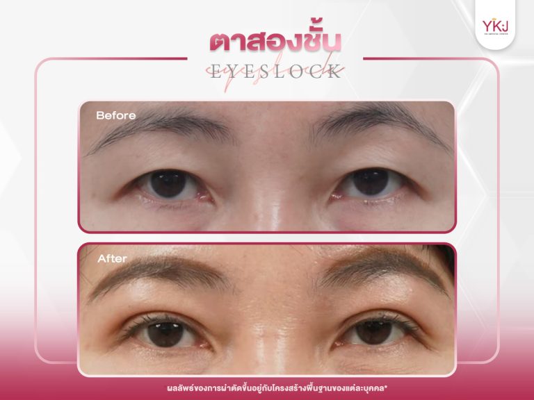 ภาพก่อนหลังทำตาสองชั้น , ภาพก่อนหลังแก้ตาสองชั้น