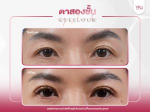 ภาพก่อนหลังทำตาสองชั้น , ภาพก่อนหลังแก้ตาสองชั้น