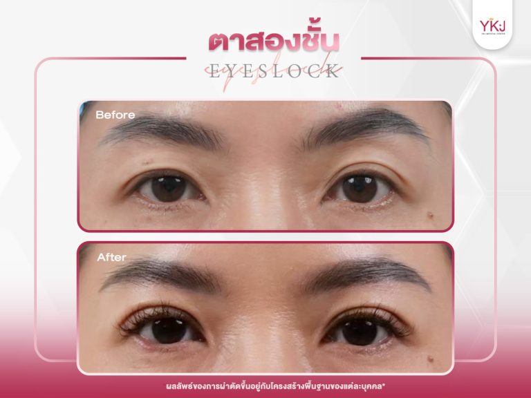 ภาพก่อนหลังทำตาสองชั้น , ภาพก่อนหลังแก้ตาสองชั้น