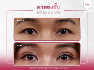 ภาพก่อนหลังทำตาสองชั้น , ภาพก่อนหลังแก้ตาสองชั้น