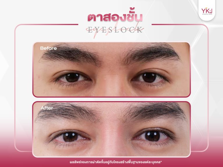 ภาพก่อนหลังทำตาสองชั้น , ภาพก่อนหลังแก้ตาสองชั้น