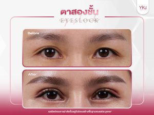 ภาพก่อนหลังทำตาสองชั้น , ภาพก่อนหลังแก้ตาสองชั้น