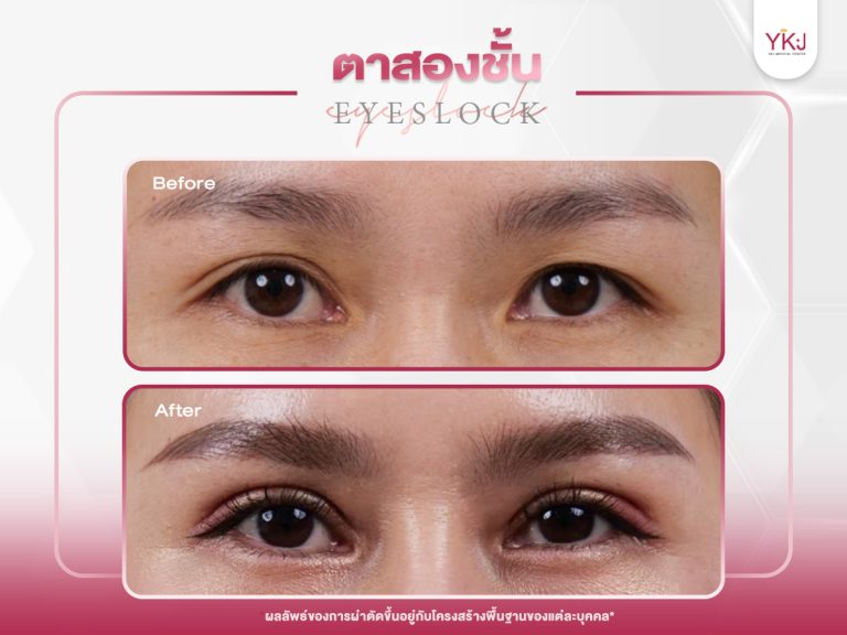 ภาพก่อนหลังทำตาสองชั้น , ภาพก่อนหลังแก้ตาสองชั้น